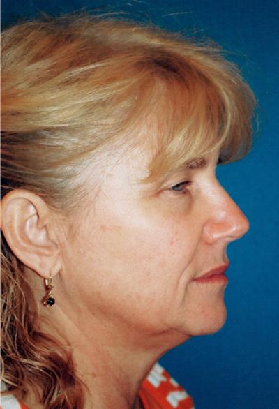 After Results for Laser Skin Resurfacing