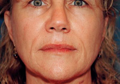 After Results for Laser Skin Resurfacing