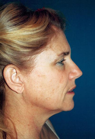 Before Results for Laser Skin Resurfacing