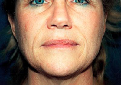 Before Results for Laser Skin Resurfacing