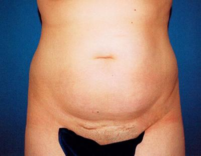 Before Results for Liposuction