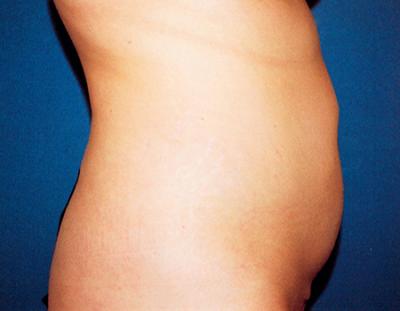 Before Results for Liposuction