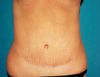 After Results for Tummy Tuck