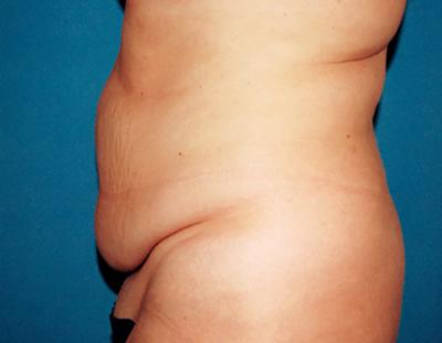 Before Results for Tummy Tuck