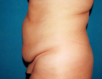 Before Results for Tummy Tuck