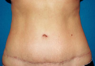 After Results for Tummy Tuck