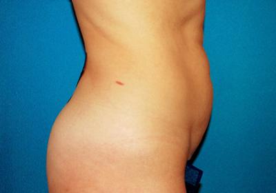 Before Results for Tummy Tuck