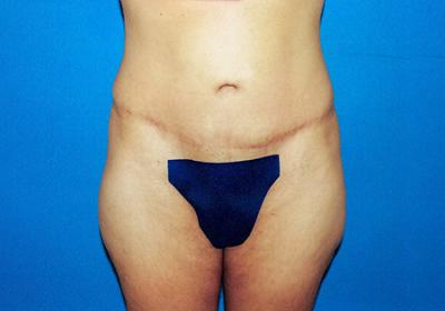 After Results for Tummy Tuck