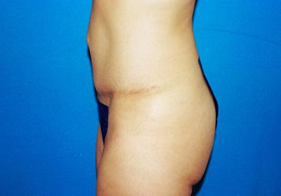 After Results for Tummy Tuck