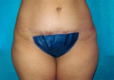 After Results for Tummy Tuck