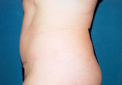 After Results for Tummy Tuck