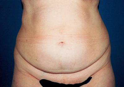 Before Results for Tummy Tuck