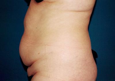 Before Results for Tummy Tuck