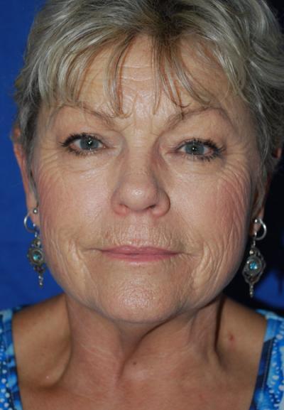 Before Results for Facelift