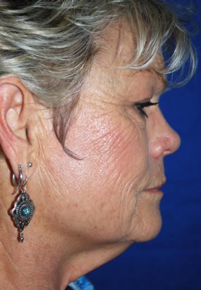 Before Results for Facelift