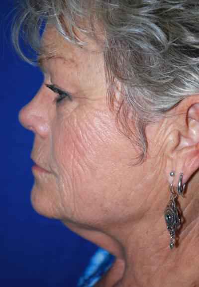 Before Results for Facelift