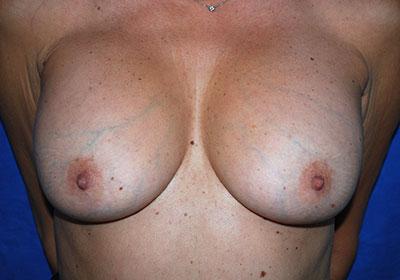 After Results for Breast Implant Replacement