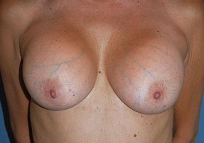 Before Results for Breast Implant Replacement