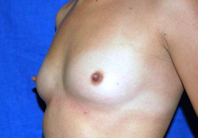 Before Results for Breast Augmentation