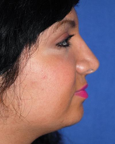 After Results for Rhinoplasty