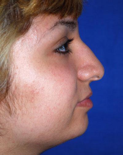 Before Results for Rhinoplasty