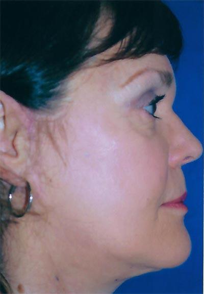 After Results for Facelift