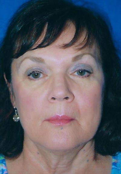 Before Results for Facelift