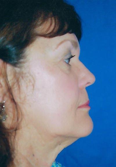 Before Results for Facelift