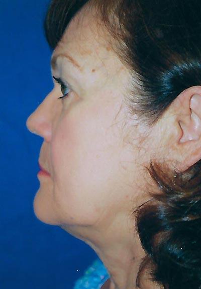 Before Results for Facelift