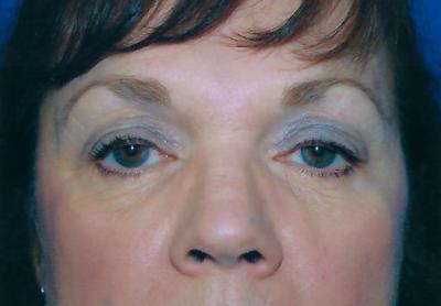 Before Results for Eyelid Surgery