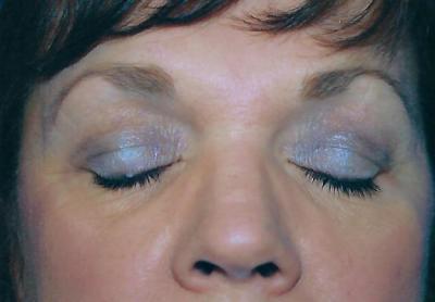 Before Results for Eyelid Surgery