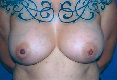 After Results for Breast Augmentation
