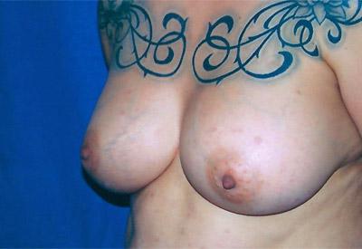 After Results for Breast Augmentation