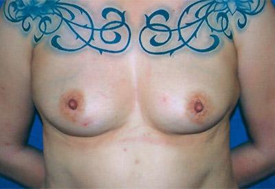Before Results for Breast Augmentation