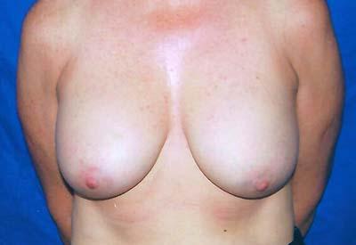 After Results for Breast Implant Replacement