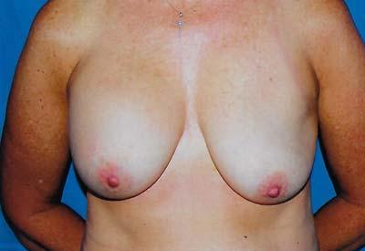 Before Results for Breast Implant Replacement