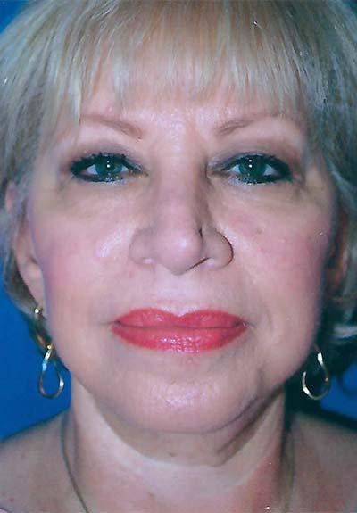 After Results for Facelift