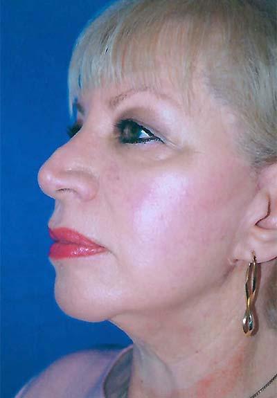 After Results for Facelift