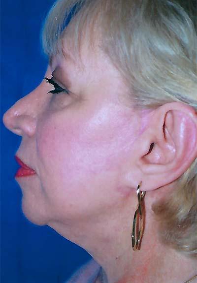 After Results for Facelift