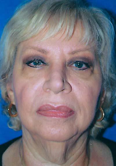 Before Results for Facelift