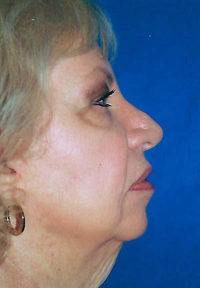 Before Results for Facelift