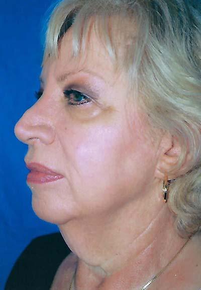 Before Results for Facelift