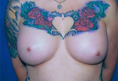 After Results for Breast Augmentation