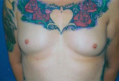 Before Results for Breast Augmentation