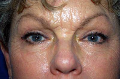 After Results for Eyelid Surgery