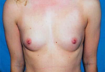 Before Results for Breast Augmentation