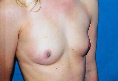 Before Results for Breast Augmentation