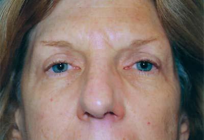 After Results for Eyelid Surgery