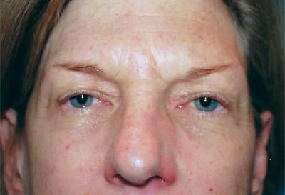 Before Results for Eyelid Surgery