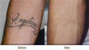 Tattoo Removal Results